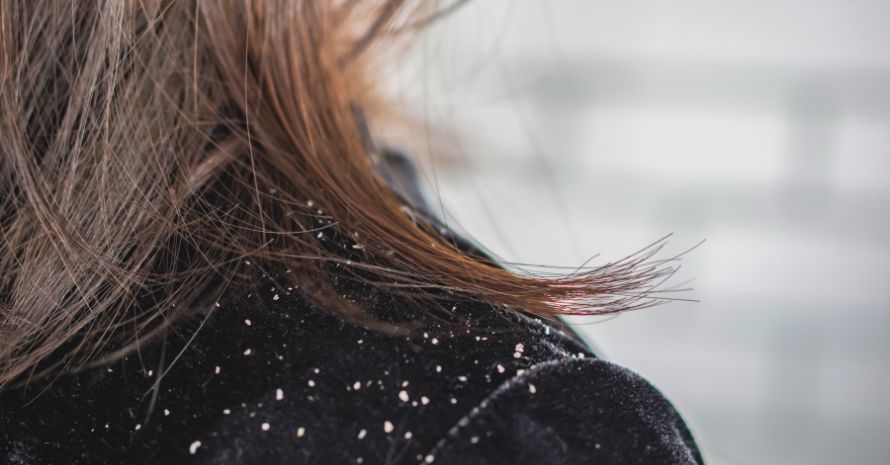 woman hair with dandruff falling on shoulders